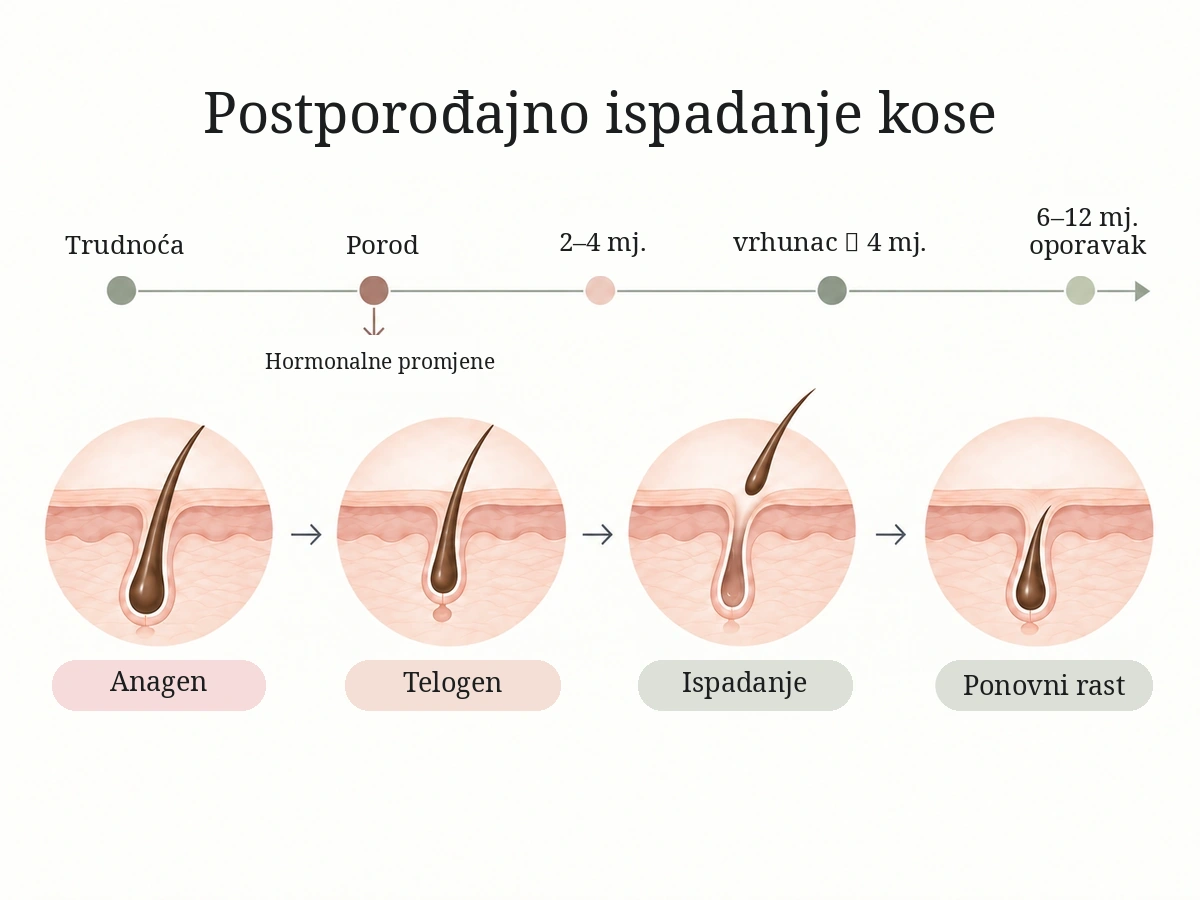 Shema postporođajnog ispadanja kose: trudnoća, hormonalne promjene nakon poroda, telogeno ispadanje nakon 2–4 mjeseca i postupni oporavak gustoće kose.
